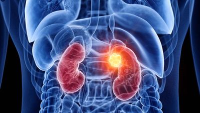 Travere Therapeutics Rallies To Buy Point As Kidney Drug Sales Rocket 182%; Anticipates FDA Priority Review For FSGS Treatment