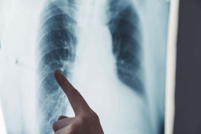 AI model being trained with NHS data from 57m people ‘could predict disease’