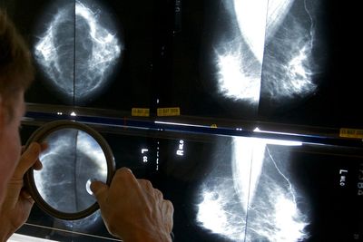 Cancer before age 50 is increasing. A new study looks at which types