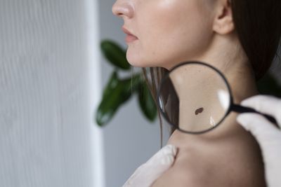 How To Tell If Your Mole Is Cancerous: Doctor Shares A Simple Guide