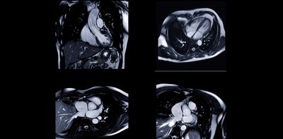 AI can guess racial categories from heart scans – what it means and why it matters