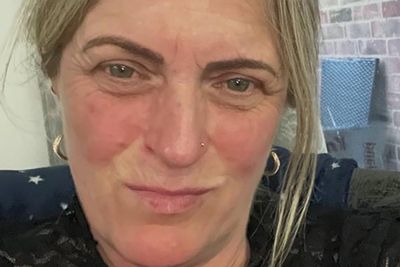 Mother left in agony after dentist broke her jaw during tooth extraction