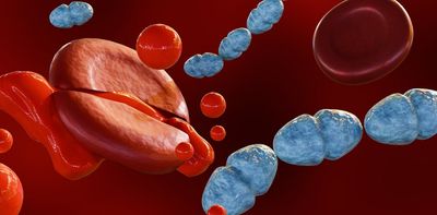 Post-sepsis syndrome: when the body recovers but the brain doesn’t