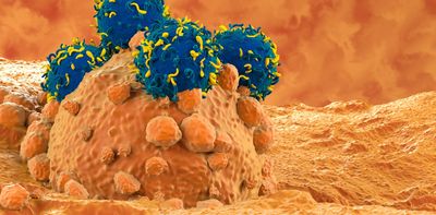 CAR-T cell therapy is revolutionising cancer treatment – here’s how it works