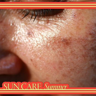 It’s Time to Treat Your Melasma Like a Dermatologist Would