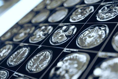 ‘Game changer’ test could revolutionise brain tumour treatment