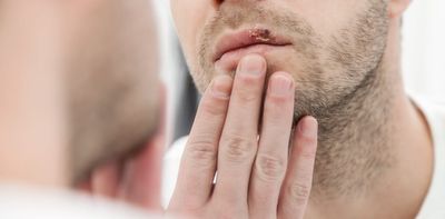 Could cold sores increase the risk of Alzheimer’s disease? A new study is no cause for panic