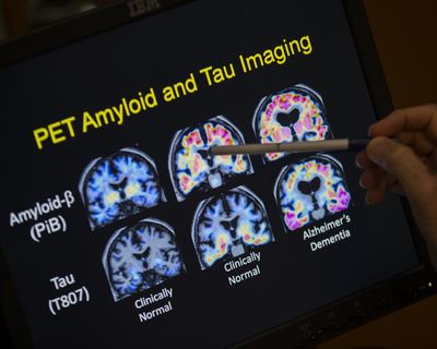 Australia approves new drug to treat early Alzheimer’s disease