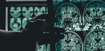 It’s unlikely a magic bullet will ever cure Alzheimer’s – maybe a magic shotgun can