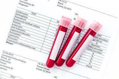 5 Simple Blood Tests That Can Tell You Almost Everything You Need to Know About Your Health