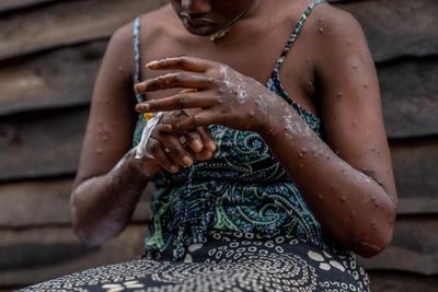 Malawi battles mpox as cases of the infectious disease surge in Africa