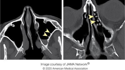 Diagnostic dilemma: Cold-water rinses left 'cobblestone' growths in woman's sinuses