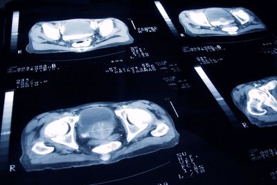 AI to help end ‘postcode lottery’ for vital prostate cancer drug