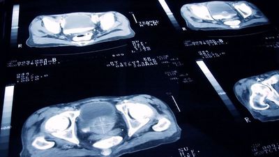 New AI test could identify which patients could benefit from promising prostate cancer drug