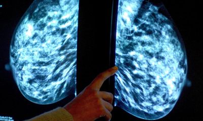 NHS could start offering breast cancer checks to women in their thirties