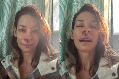Evangeline Lilly shows off bloody facial injuries after fainting and falling ‘face first’ into a boulder