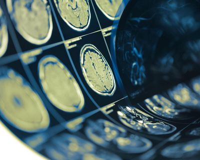 ‘Gift of life’: experts hail neck and head cancer breakthrough