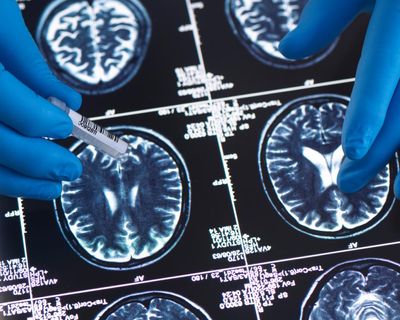 Younger generations less likely to have dementia, study suggests