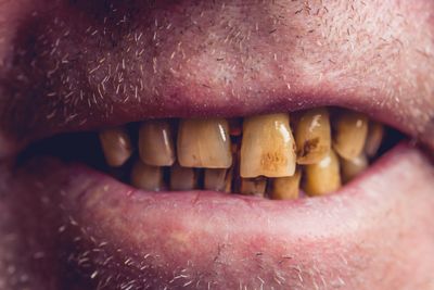 Dental Help: 8 Clues Your Dental Hygiene Is Turning Her Off