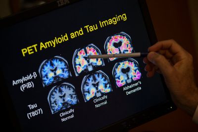 Weight-loss drugs among breakthrough trials offering ‘hope’ for dementia prevention