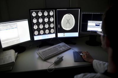 ‘Hope on the horizon’ as drugs assessed for Alzheimer’s prevention