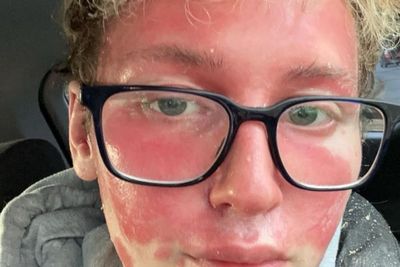 Fillers triggered painful skin condition that left teenager looking ‘like an alien’