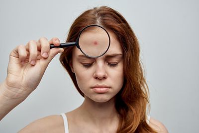 5 Ways to Easily Help Your Child Get Rid of Acne