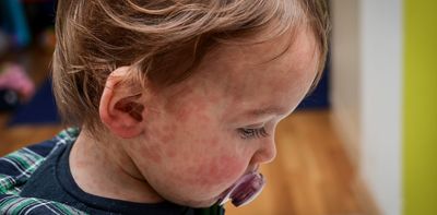 Measles cases are surging globally. Should children be vaccinated earlier?