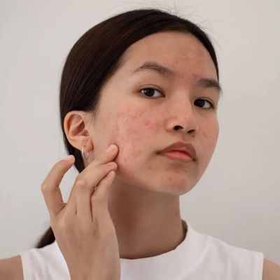 Forget Expensive Dermatology Appointments, It’s So Easy To Get Help With This New Skin Service At Boots