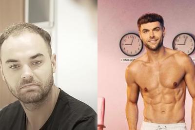 Love Island star unrecognisable in pre-hair transplant video