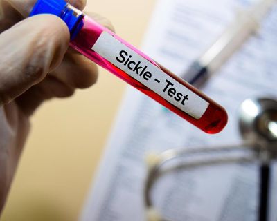 Sickle cell patients to have quicker and more accessible treatment in England