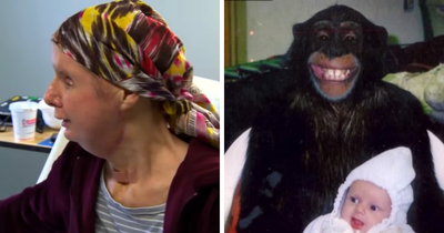 Woman Whose Face Was Torn Apart By Chimpanzee Reveals Her Appearance 16 Years After Face Transplant