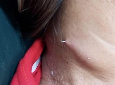 Fishbone stuck in woman's throat exits through her neck