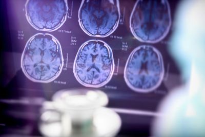 Why two Alzheimer’s drugs were rejected for use on the NHS