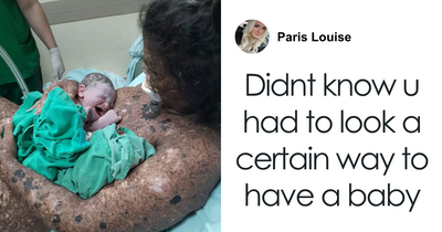 Mom With Rare Skin Condition Gets Treatment After Trolls Call Her ‘Irresponsible’ For Having Baby