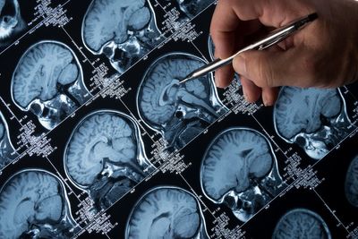 The simple blood test that can predict Alzheimer’s decline