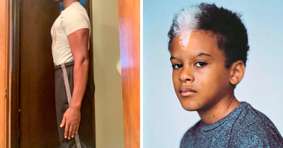 44 Photos Of Unique People’s Features Because Of Their Rare Genetics