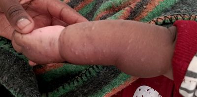 Mpox in Sierra Leone: what’s behind the recent surge and why west Africa is at risk