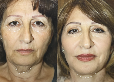 The Science of Balance: Dr. Chobanian's Approach to Facial Harmony