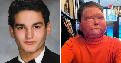 Man Who Got A New Face Transplanted From 47-Year-Old Donor Reveals His ‘Painful’ 3-Month Coma