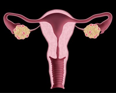 Living with polycystic ovary syndrome can be difficult and lonely