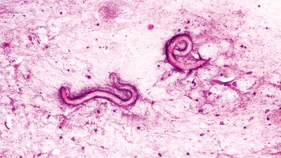 Man's body crawling with parasitic worms after infected kidney transplant at US hospital