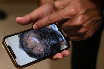 Hair clinic ordered to pay over £5,000 to man who claims not ‘even 1% improvement’