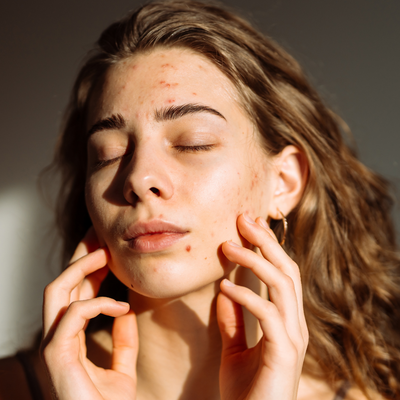 I Just Turned 30, and Have Breakouts for the First Time—3 Top Derms Explain How Skin Shifts From Your 20s to 30s