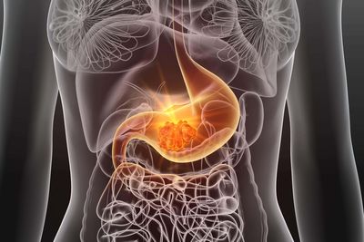 Common bacteria ‘fuels millions of cases of stomach cancer across the globe’