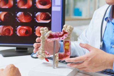 Obesity linked to increased risk of colon cancer