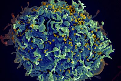 UN says if US funding for HIV programs is not replaced, millions more will die by 2029
