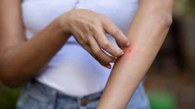 I asked pest experts why mosquitoes always bite me — their answer surprised me