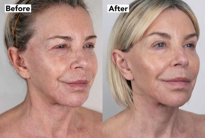 Leslie Ash, 65, feels '10 years younger' thanks to £4,500 facelift after 'depression' about her looks