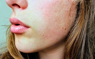 Caroline Hirons: Any products you use to combat hyperpigmentation are a waste of time if you don’t use SPF